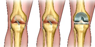 what is osteoarthritis