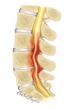 With osteochondrosis of the thoracic spine, compression of the spinal canal occurs