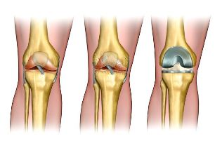 the degree of arthrosis