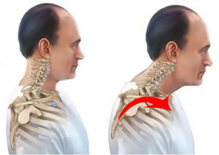 healthy and diseased spine