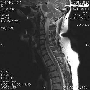 Osteochondrosis and spondylosis of the cervical spine