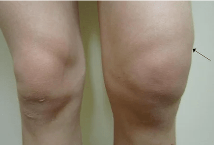Knee joint hemarthrosis