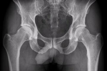 Diagnostic options for osteoarthritis of the hip joint