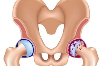 Stages of development of osteoarthritis of the hip joint