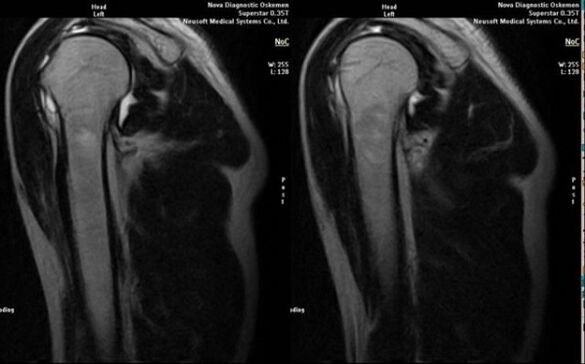 x-ray to diagnose shoulder osteoarthritis