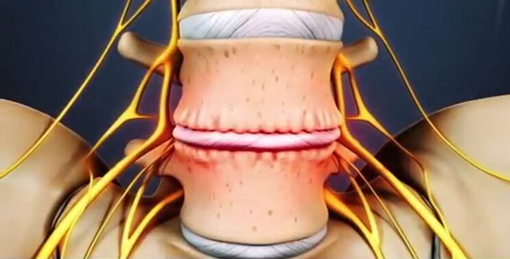 spinal injuries due to osteochondrosis